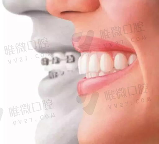 做牙齿矫正的好处（牙齿矫正的利弊有哪些）(图1)